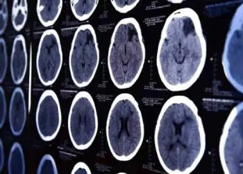 The Corona Radiata and Stroke